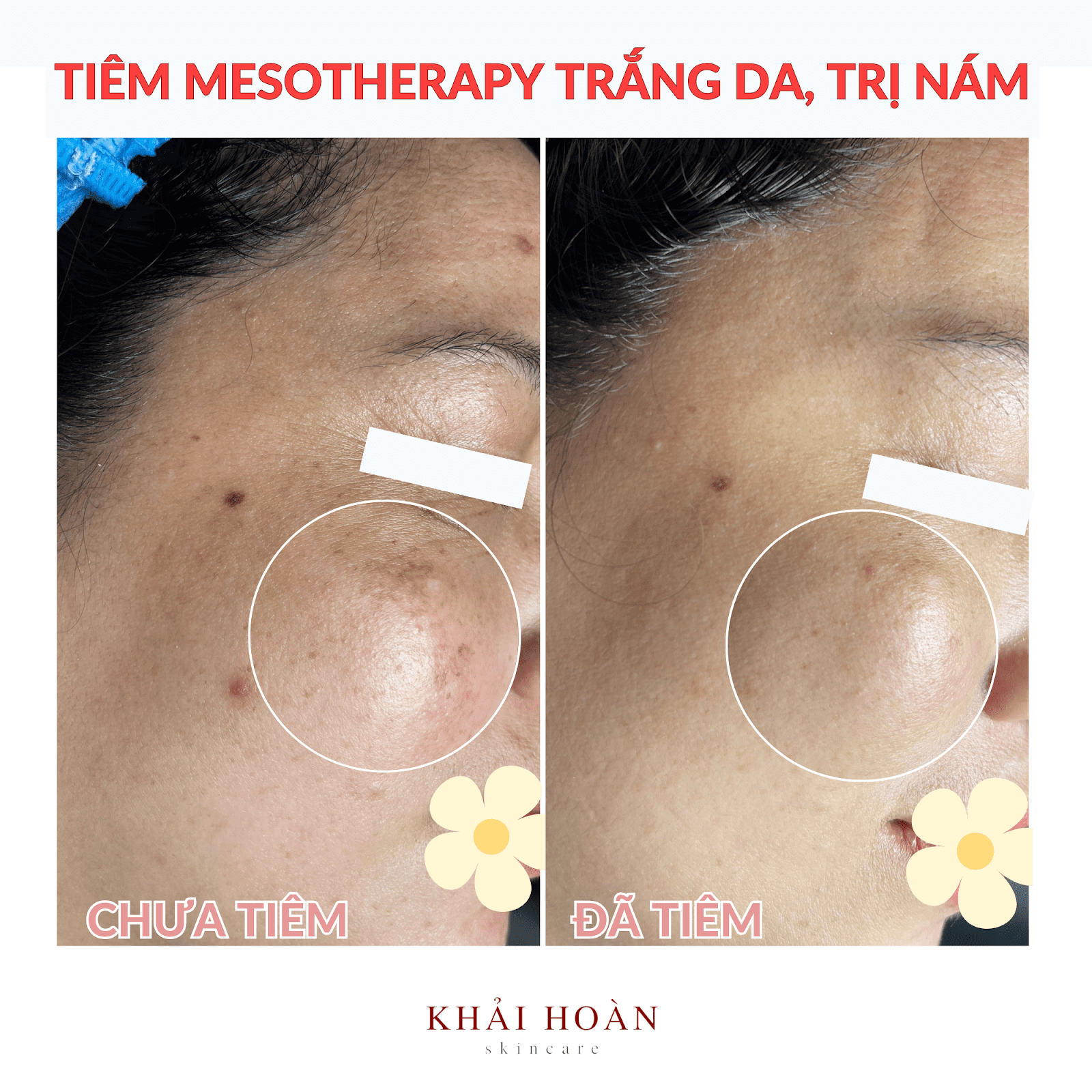 5 Điều Bạn Cần Biết Từ Chuyên Gia Khi Lựa Chọn Tiêm Meso 10 5 dieu meso 4