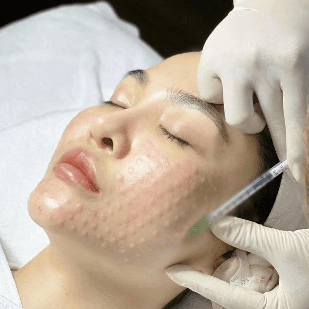 5 Điều Bạn Cần Biết Từ Chuyên Gia Khi Lựa Chọn Tiêm Meso 6 5 dieu meso