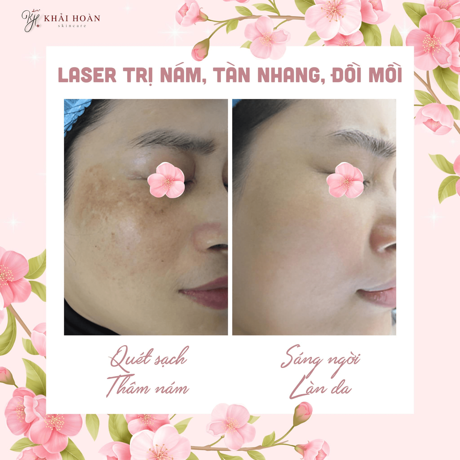 Bí Quyết Chăm Da Đúng Cách Sau Khi Điều Trị Nám Bằng Laser 5 ban laser tri nam 1