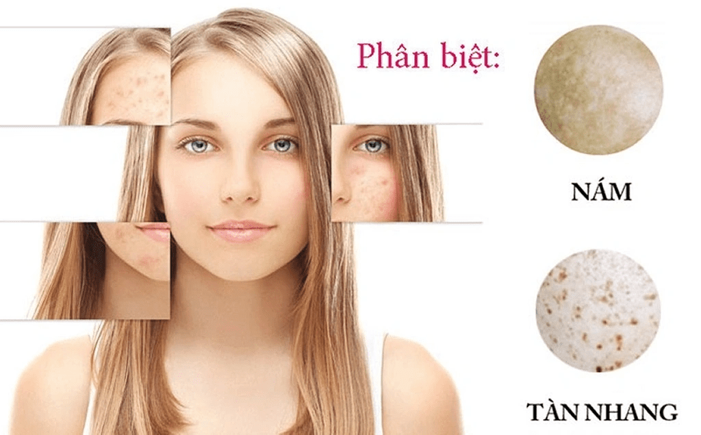Phân Biệt Nám Da Và Tàn Nhang Để Điều Trị Hiệu Quả Và Tối Ưu 4 phan biet nam da 1