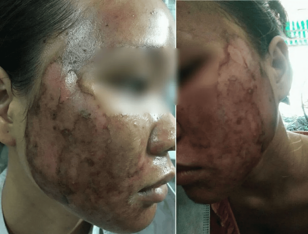 Những Điều Quan Trọng Cần Biết Khi Làm Đẹp Bằng Peel Da 7 sai lam peel da 1