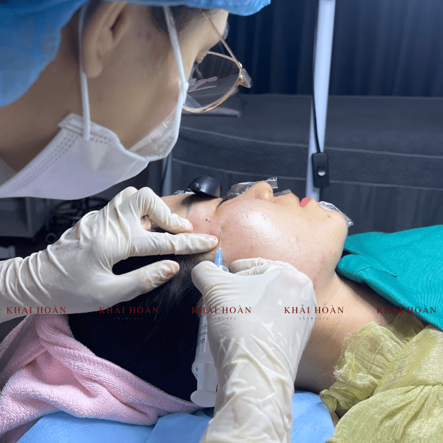 1 Liệu Trình Trị Sẹo Rỗ Bao Nhiêu Tiền Từ Khải Hoàn Skincare